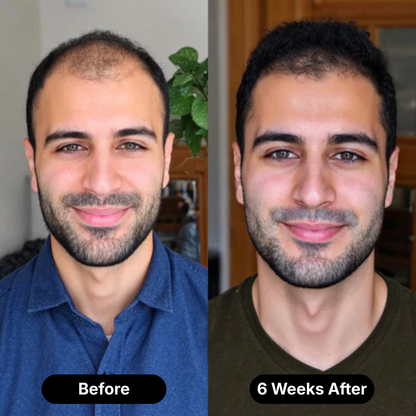 Scalptex Targeted Scalp Micro-Infusion System