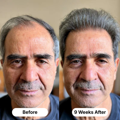 Scalptex Targeted Scalp Micro-Infusion System