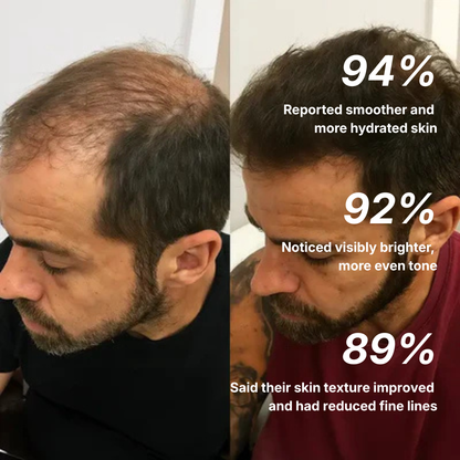 Scalptex Targeted Scalp Micro-Infusion System